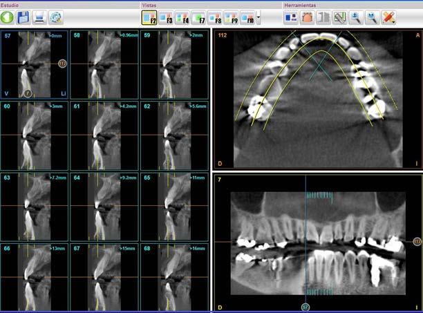 quantificare il volume del restringimento delle vie