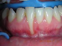 Case report: Dott. Vincenzo Carbone Risoluzione di una grave recessione parodontale mediante trattamento ortodontico linguale senza attacchi. Introduzione: Fig 1.