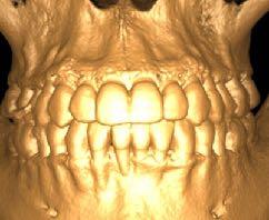 Vista frontale immagine di ricostruzione volumetrica. Bibliografia 1. Macchi A, Cirulli N. "Fixed Active Retainer for Minor Anterior Tooth Movement". Journal of Clinical Orthodontics, 20