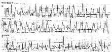 Linee guida AIAC all impianto di dispositivi elettronici cardiovascolari impiantabili update 2011 13. INDICAZIONI ALL IMPIANTO DI DEFIBRILLATORE AUTOMATICO NELLA CARDIOMIOPATIA IPERTROFICA Figura 6.