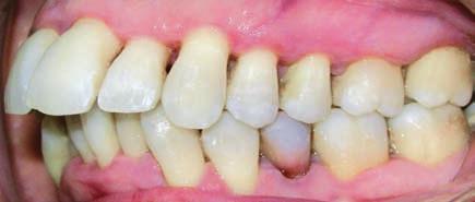 ortodontico. Nel frattempo, sono state eseguite le estrazioni dei III molari.