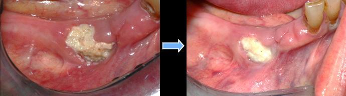 FATTORI DI RISCHIO LOCALI CHIRURGIA DENTOALVEOLARE PARODONTITE PERIMPLANTITE INFEZIONI ODONTOGENE PROTESI