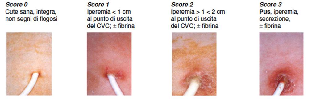 Infezioni Quando siamo in presenza di sospetta o certa infezione (score 1-2-3) dopo aver