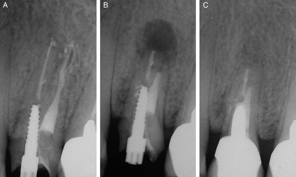 Micro-endodonzia chirurgica 95 Figura 30 A-B. La frattura verticale apicale è ora evidente. C.