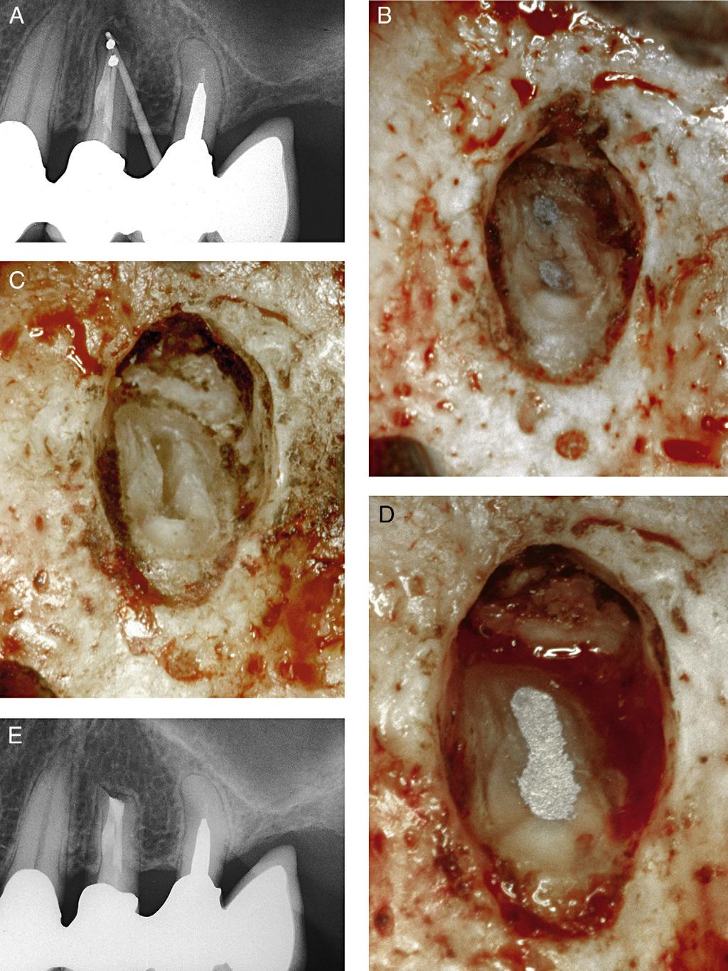 98 A. Castellucci, M. Papaleoni Figura 36 Il dente è stato trattato con apicectomia e otturazione retrograda alcuni anni prima.