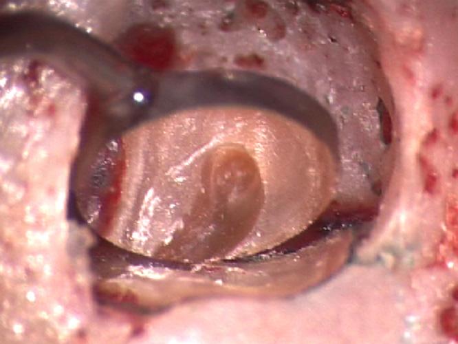 Micro-endodonzia chirurgica 99 Figura 39 I micro-specchietti di Gary Carr.