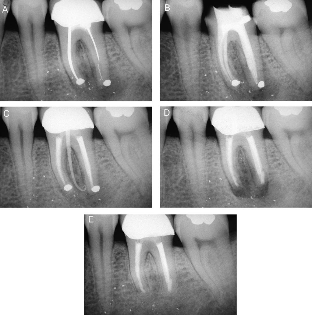 Micro-endodonzia chirurgica 85 Figura 2 Un tipico esempio di chirurgia endodontica: l intervento è stato eseguito dopo il fallimento di una terapia ortograda male eseguita. A.