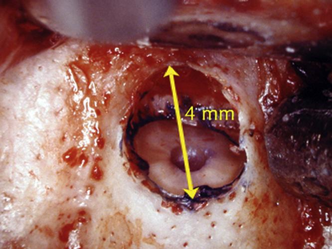 Micro-endodonzia chirurgica 87 Figura 6 La breccia ossea deve essere sufficientemente ampia da consentire l introduzione delle punte da ultrasuoni.