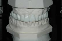 Posizionamento della cresta incisale -lunghezza dentale - DVO: fonema S Analisi dentale e gengivale Forma, proporzione, posizione e colore Come definire e visualizzare le modifiche di forma