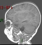 Udito anacusia EEG scarsamente organizzato con attività asimmetrica (emisfero dx più lenta, attività