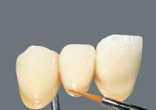 Stratificazione BASIC Successivamente eseguire correzioni di forma partendo dalla zona cervicale con BASE DENTINE, del corpo del dente fino all area incisale con ENAMEL. 2.