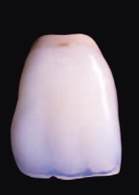 in:joy in:joy & Genios: una squadra vincente Le protesi combinate presentavano solitamente il problema che i rivestimenti in resina e i denti protesici del commercio erano molto difficili da
