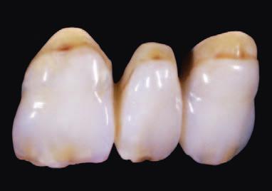 in:joy è un materiale che facilita il rapido e semplice adattamento, indipendentemente che i denti protesici siano standard o di alta qualità.