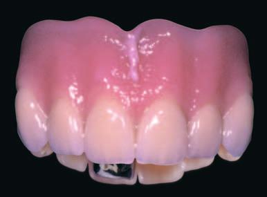Godete dei numerosi vantaggi della nostra linea di denti protesici Genios, per esempio i filetti interdentali brevettati che consentono di evitare i famosi buchi neri.