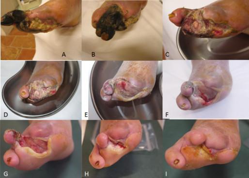 Le gravi infezioni del piede diabetico solitamente sono infezioni polimicrobiche Questa diversità di
