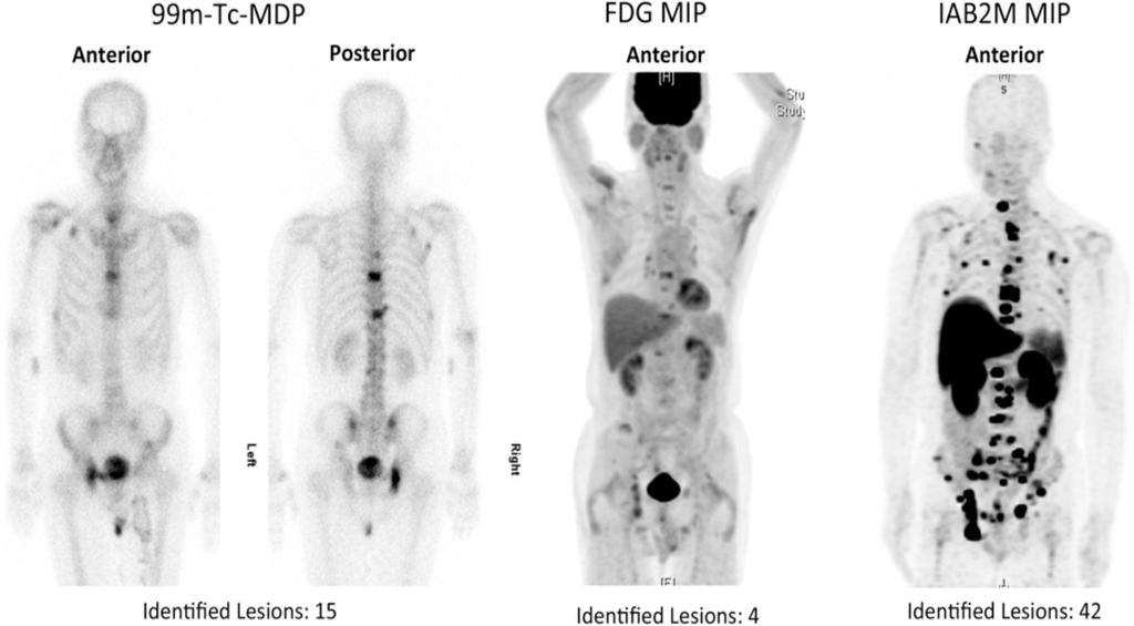 Molecular imaging Zr-89 labeled anti-