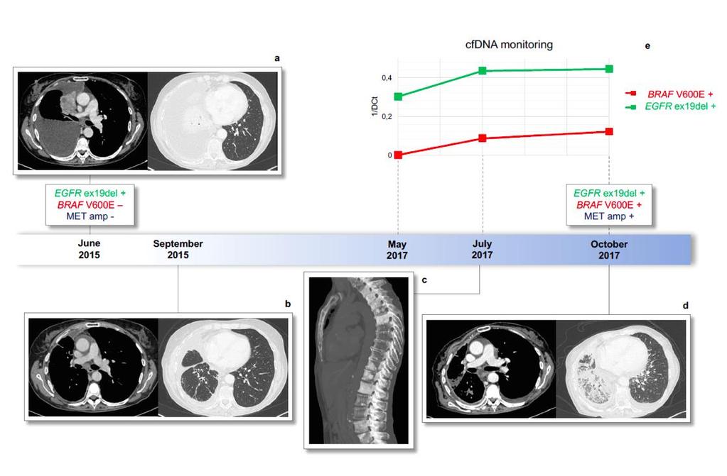 Osimertinib in I linea: mecc.