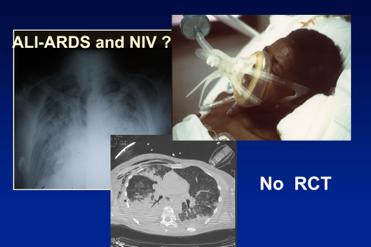 Applicazioni NIV esclusive per ambienti rianimatori (ICU) ALI: acute lung injury (PaO2/FiO2 :