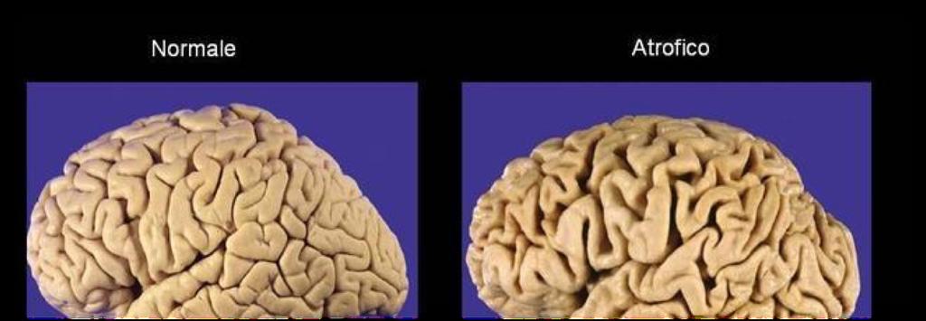 La degenerazione nervosa Le alterazioni delle diverse aree del cervello compromettono le funzioni cognitive che ci permettono di conoscere l ambiente, di interagire con esso e di organizzare un