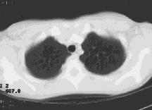 Analisi di CT polmonari Screening