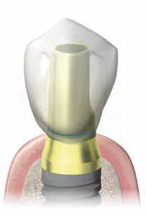 SISTEMA IMPLANTOLOGICO Raccomandazioni protesiche Il collo degli impianti Prama è caratterizzato da un tragitto cilindrico di 0.