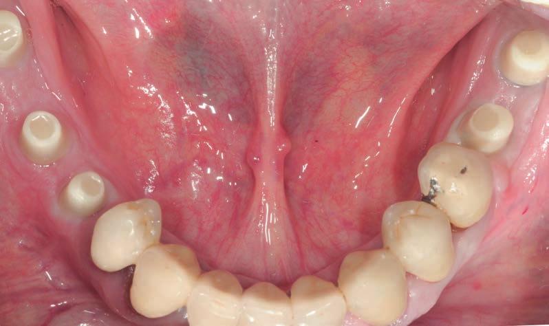 Nella stessa seduta è stata quindi eseguita al paziente una CBCT a basso dosaggio, la