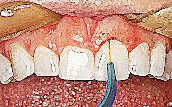 15-13.00 Laser in endodonzia Relatore: Dr. Fabio Piccotti 14.00-15.00 Sbiancamento Relatore: Dr.