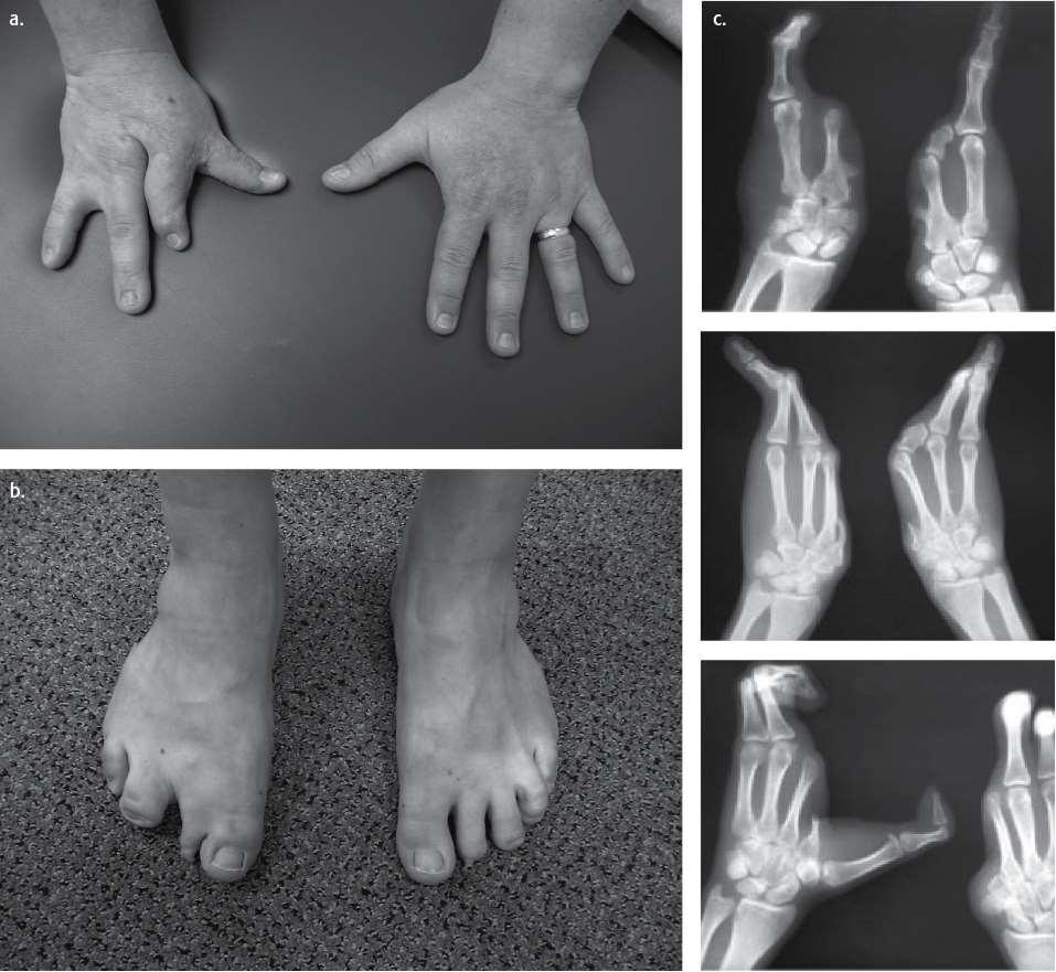 Ectrodattilia (SPLIT-HAND/FOOT MALFORMATION 3;