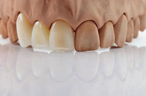 La 2 a cottura della dentina viene effettuata a 770 C. Opzione 1 Il restauro può essere realizzato con supercolori e glasura.