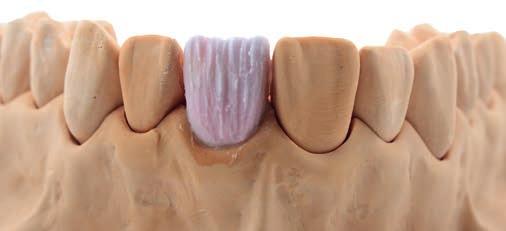 Applicazione della dentina opaca nell area cervicale e linguale.