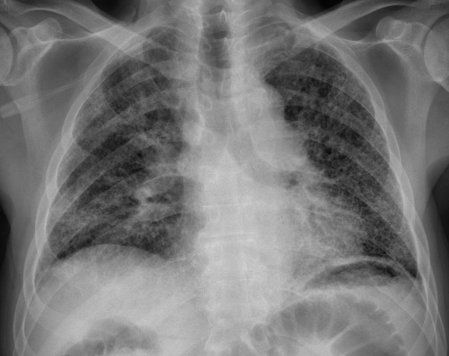 Opacità interstiziali aspetto radiologico caratteristico qualsiasi sia il substrato anatomopatologico