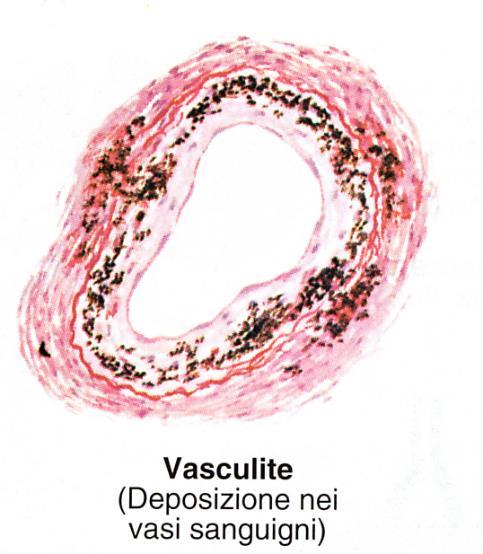 membrane basali dei vasi dei glomeruli renali o delle membrane