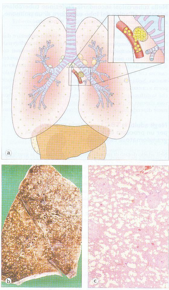 2. la disseminazione per via ematica provoca tubercolosi miliare (formazione di numerose lesioni