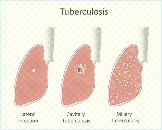 Vaccinazione anti-tubercolare -BCG Il DPR 465/2001 ha drasticamente limitato le indicazioni di uso di questa vaccinazione ai soli operatori sanitari ad alto rischio di esposizione a ceppi di bacilli