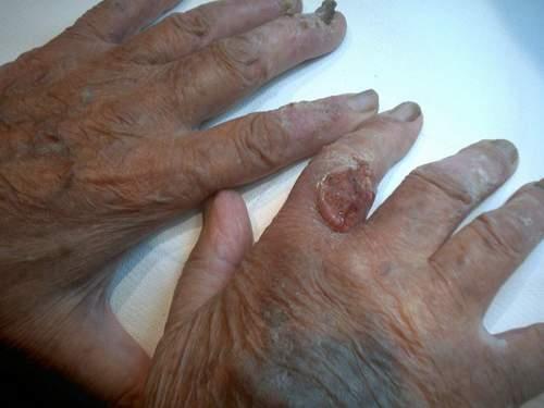 Action physiologique du rayonment du radium sur la peau e sur les graines (Becquerel) Les rayons du radium agisse énergiquement sur la peau.
