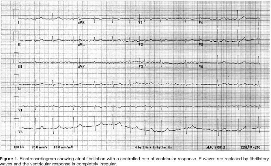 L FA è la tachiaritmia più frequente nella pratica clinica,