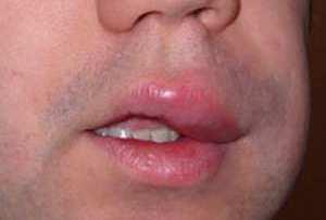 Angioedema: rigonfiamento