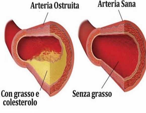 STRATIFICAZIONE DEL RISCHIO CV Gli organi bersaglio maggiormente