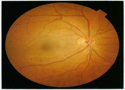 STRATIFICAZIONE DEL RISCHIO CV Gli organi bersaglio maggiormente