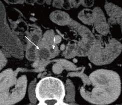 Identificazione della lesione: diagnosi differenziale Double duct sign Altamente suggestivo ma NON diagnostico Patologie maligne