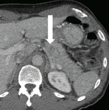 del pancreas e parenchima normale