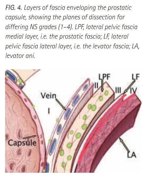Grade 2: incision through the Denonvilliers (leaving deeper layers on the rectum) and LPF is taken just outside the layer of veins of the prostate capsule.