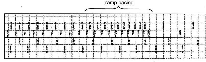 ATP: un esempio 1 2 3 1. Riconoscimento di aritmia atriale (ciclo medio 250 msec) 1.