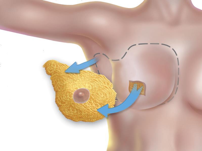 all incremento di mastectomie conservative per i DCIS (nipple e