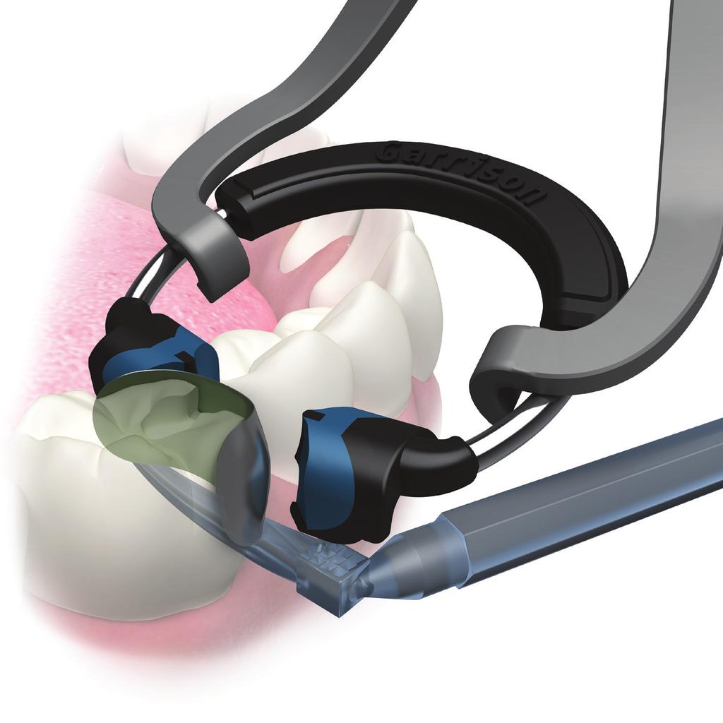 appositamente per l odontoiatria adesiva e consentono di ottenere costantemente punti di contatto efficaci.