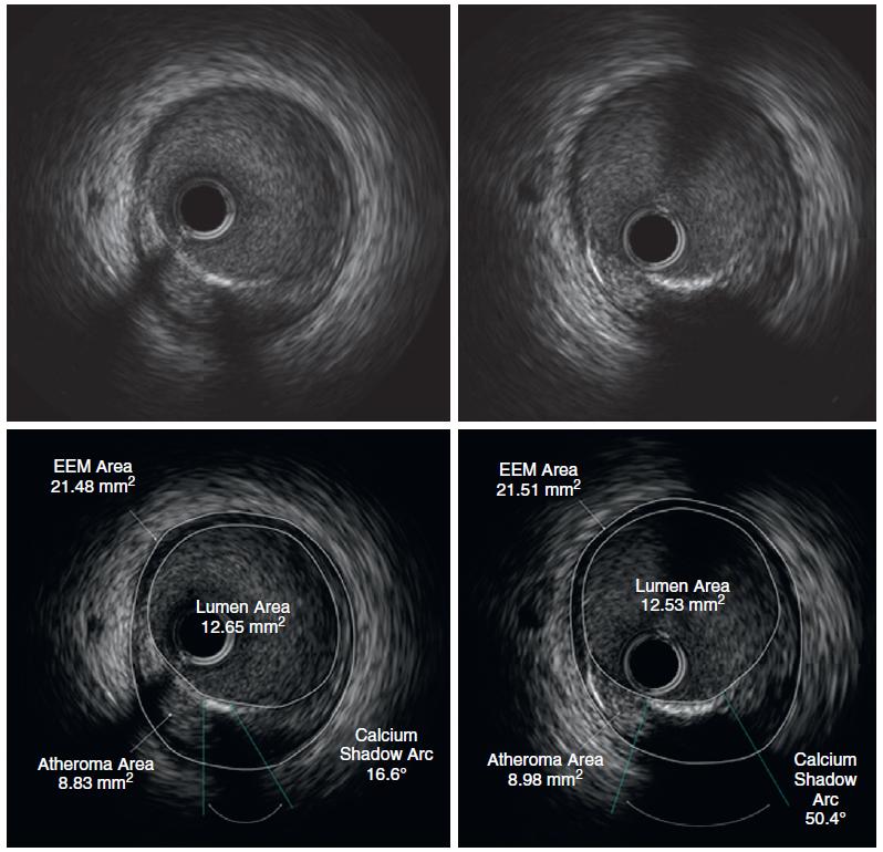 Analisi post-hoc: 8 studi randomizzati prospettici che utilizzano la tecnica IVUS.