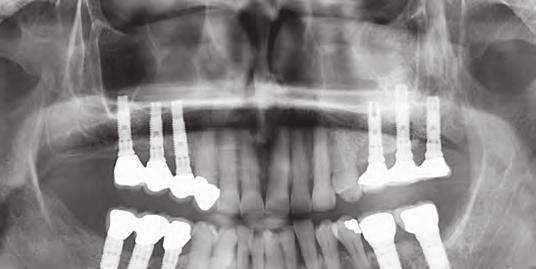 Questo caso clinico risale al 1997 ed ha follow-up di 20 anni. La regione interessata è il molare mascellare destro, non era curabile a causa di un difetto parodontale ed endodontico.