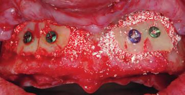 2 Vista vestibolare intraorale con cresta alveolare atrofica.