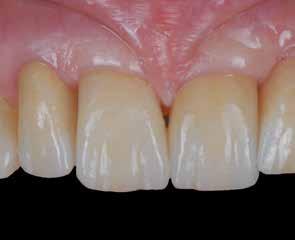 sanguinamento. A seguito della preparazione dell elemento dentale eseguita con frese a grana grossa, l area di chiusura è ruvida ed irregolare.