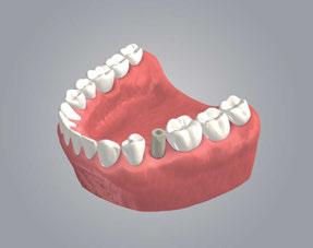 Fase 4 Inserimento Servendosi della vite, montare il corpo di scansione Mono all impianto, analogo o componente secondaria. Utilizzare il cacciavite Straumann SCS.